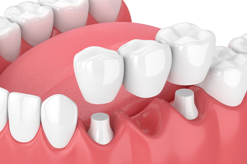 Dental Bridges Lexington