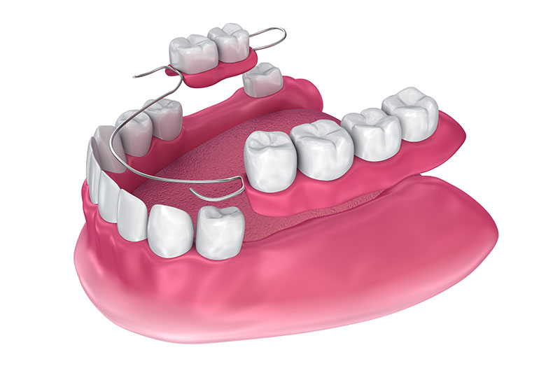 Partial Dentures Lexington