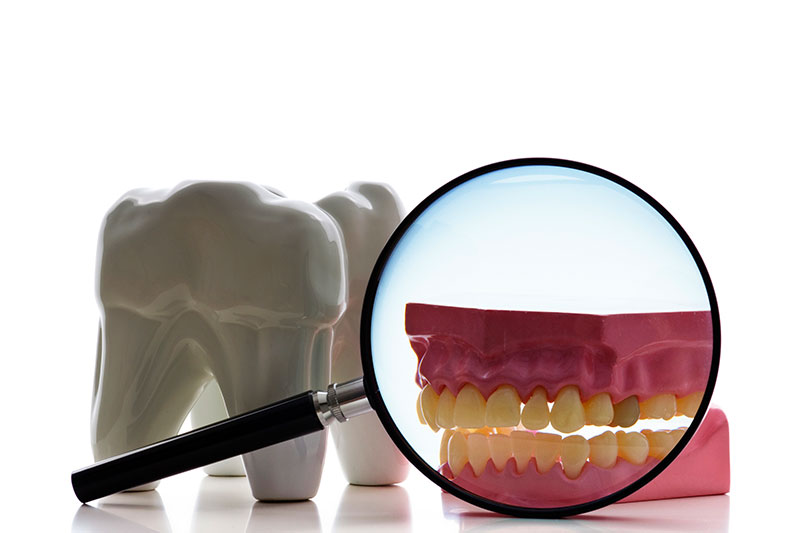 Root Canal in Lexington