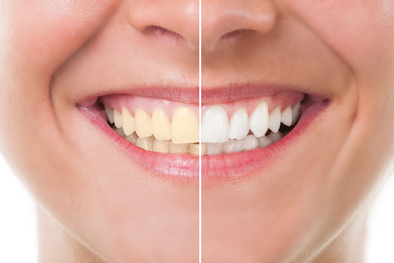 Teeth Whitening in Lexington