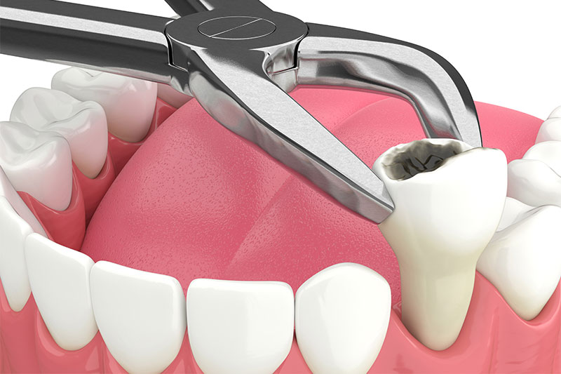 Tooth Extractions Lexington