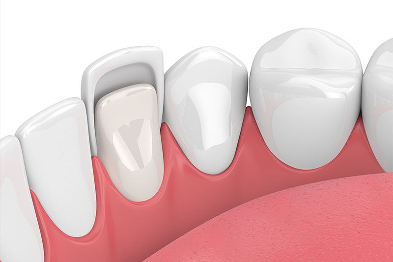 Dental Veneers Lexington